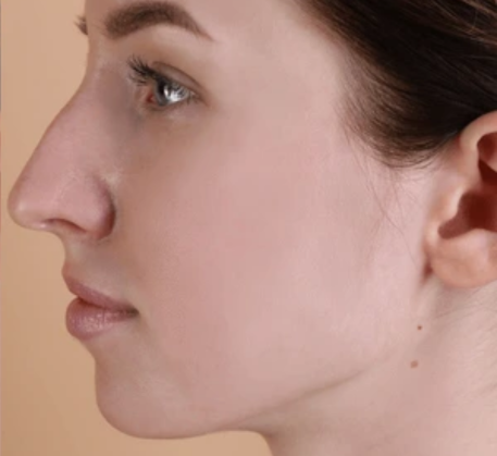 1747368952_acne-treatment-after (2).png